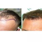 Trapianto di capelli? 7 consigli per evitare brutte sorprese